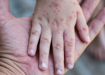 Brote de Coxsackie en primaria de Puebla: niños en aislamiento