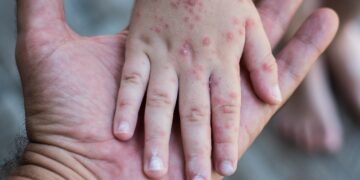 Brote de Coxsackie en primaria de Puebla: niños en aislamiento